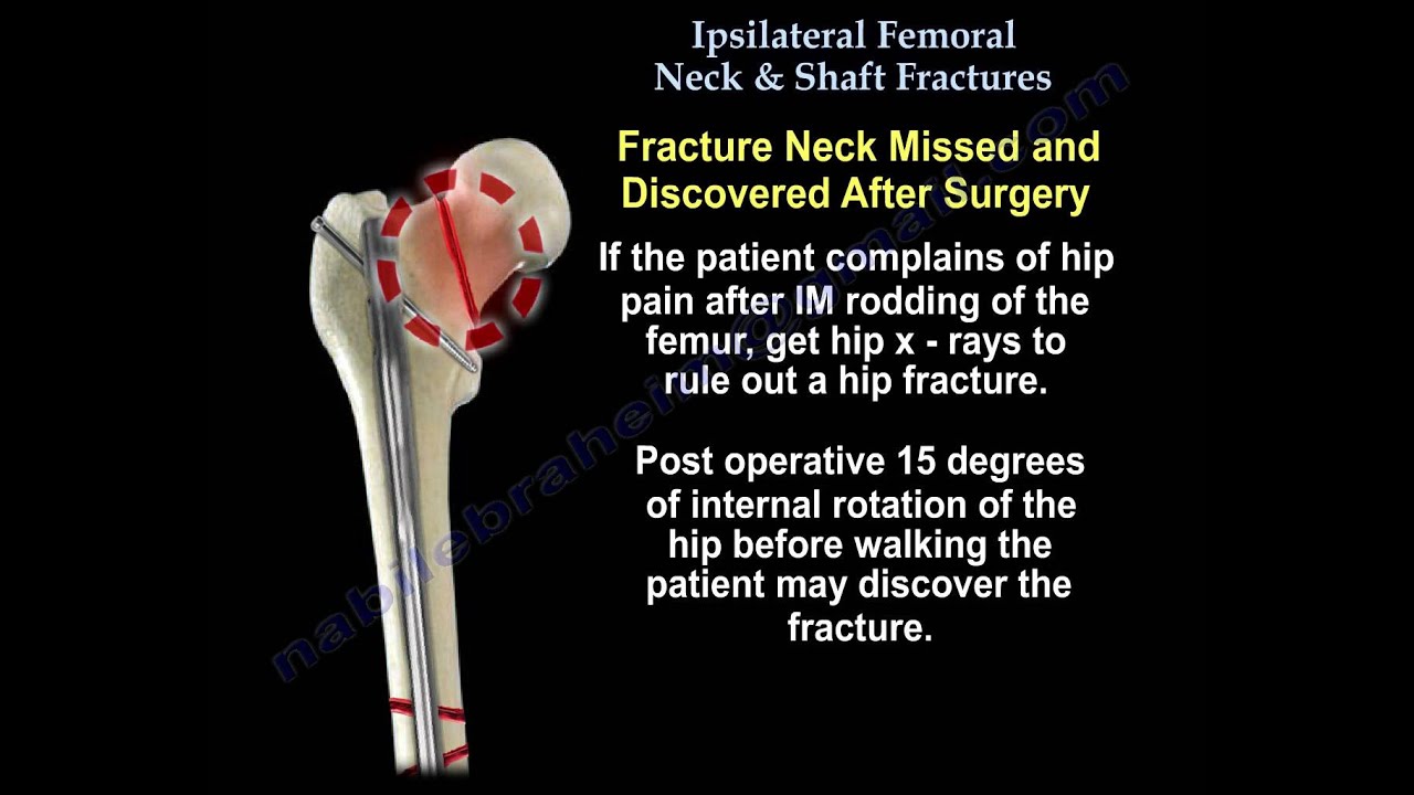Femoral Neck Fracture Surgery