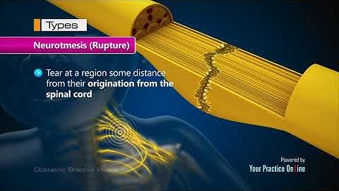 Obstetrical Brachial Plexus injury