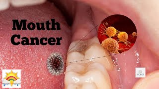 Mouth Cancer Vlog: Cancer Grade Revealed + First Six Week Follow Up Appointment...