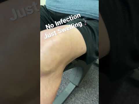 Video: Fabio Aru lider af hævede knæ efter træningsulykke