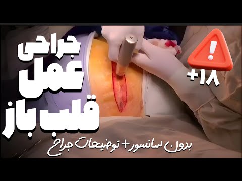 جراحی عمل قلب باز  بدون سانسور توضیحات جراح ۱۸