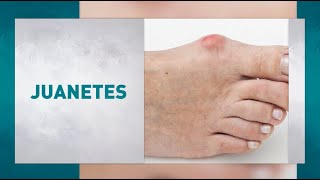 Juanetes o Hallux Valgus. Síntomas, causas y tratamiento.