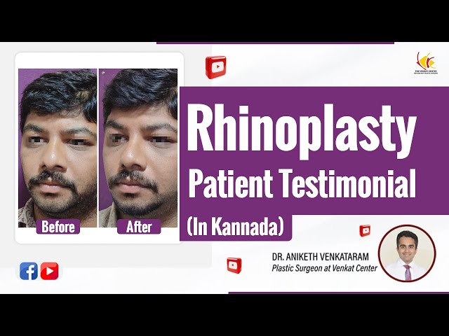 Rhinoplasty & Septoplasty: Was It Worth It? Real Patient Review | Venkat Center Bangalore