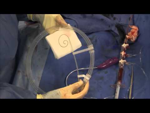 TAVI implantation by Dr Iqbal Malik- Medtronic Evolut Valve