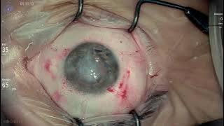 Part3 Gore tex IOL fixation, iridoplasty , PPV and endolaser Lukan Mishev live stream