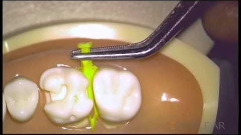 Bioclear Diamond Wedges