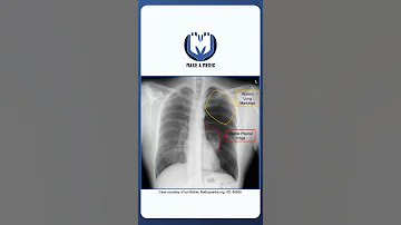 Pneumothorax On A Chest X Ray Medicine 