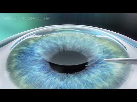 Video: SMILE-Geschichte (Small Incision Lenticule Extraction), Grundlagen Einer Neuen Refraktiven Operationstechnik Und Klinische Ergebnisse