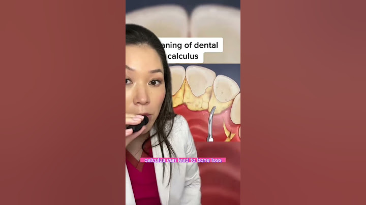 How a dental cleaning works. #dentist #cleaning #calculus