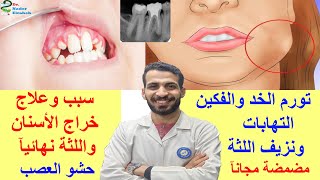 سبب وعلاج خراج الأسنان واللثة نهائيآ_تورم الخد والفكين_التهابات ونزيف اللثة وألم الأسنان_مضمضة مجانآ