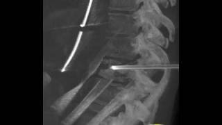 Bone Biopsy using 3D Imaging