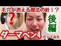 【後編】毛穴が改善「ダーマペン４」徹底検証！ダウンタイム全部お見せします！【経過報告②】