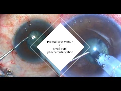 The Peristaltic Vs the Venturi machine in small pupil phacoemulsification