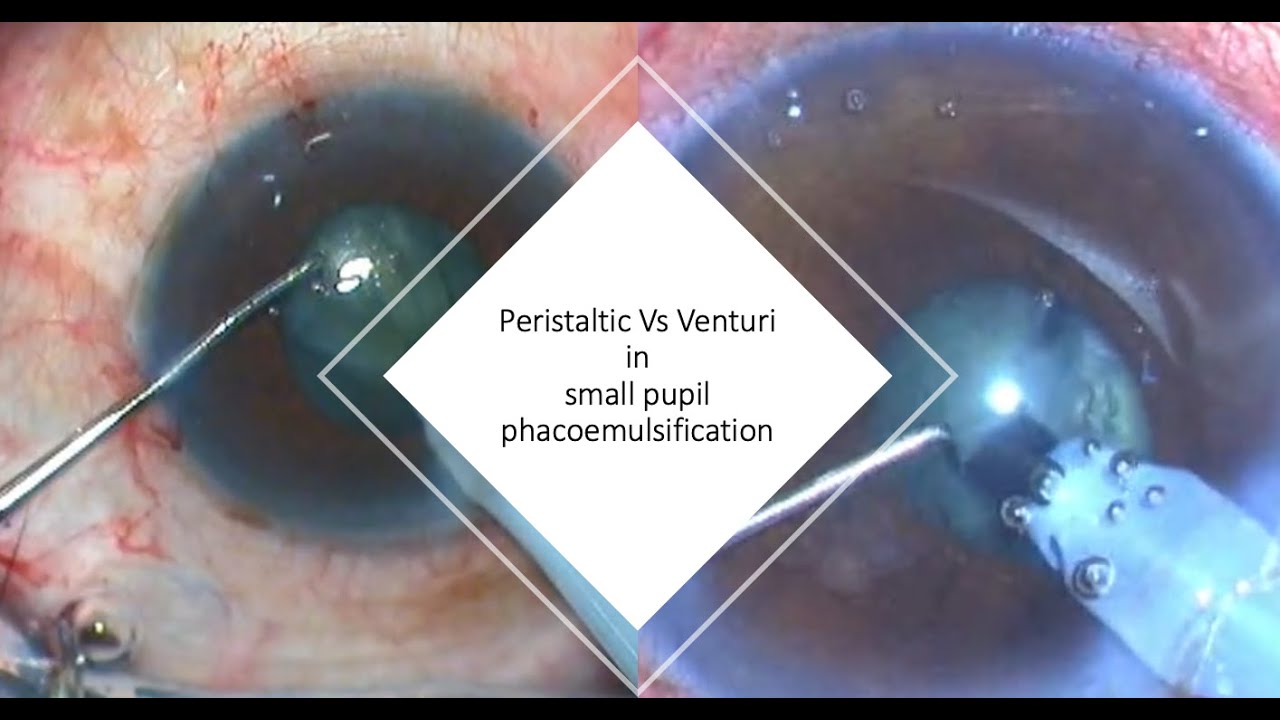 The Peristaltic Vs the Venturi machine in small pupil