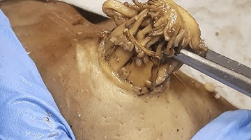 [ASMR] Giant Blackhead Removal, Most Satisfying Deep Clean Dr. Pimple Popper 2611ss 112459