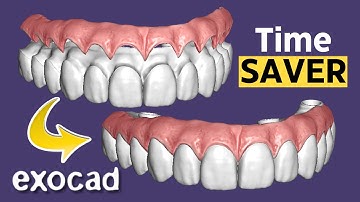 Make PMMA FASTER with this Trick! EXOCAD 3.2 Elefsina