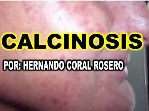 Vídeo: Calcinosis Cutis: Tratamiento, Diagnóstico, Causas Y Síntomas