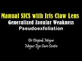 Manual sics with iris claw lens generalised zonular weakness  pseudoexfoliation dr deepak megur