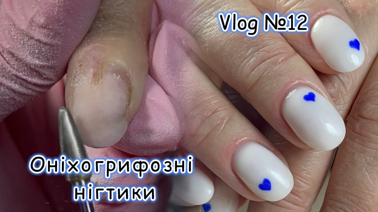 💅ПОКРИВАЮ ТРАВМУ  | Клюючі нігті | Манікюр на Valentine's day 💙