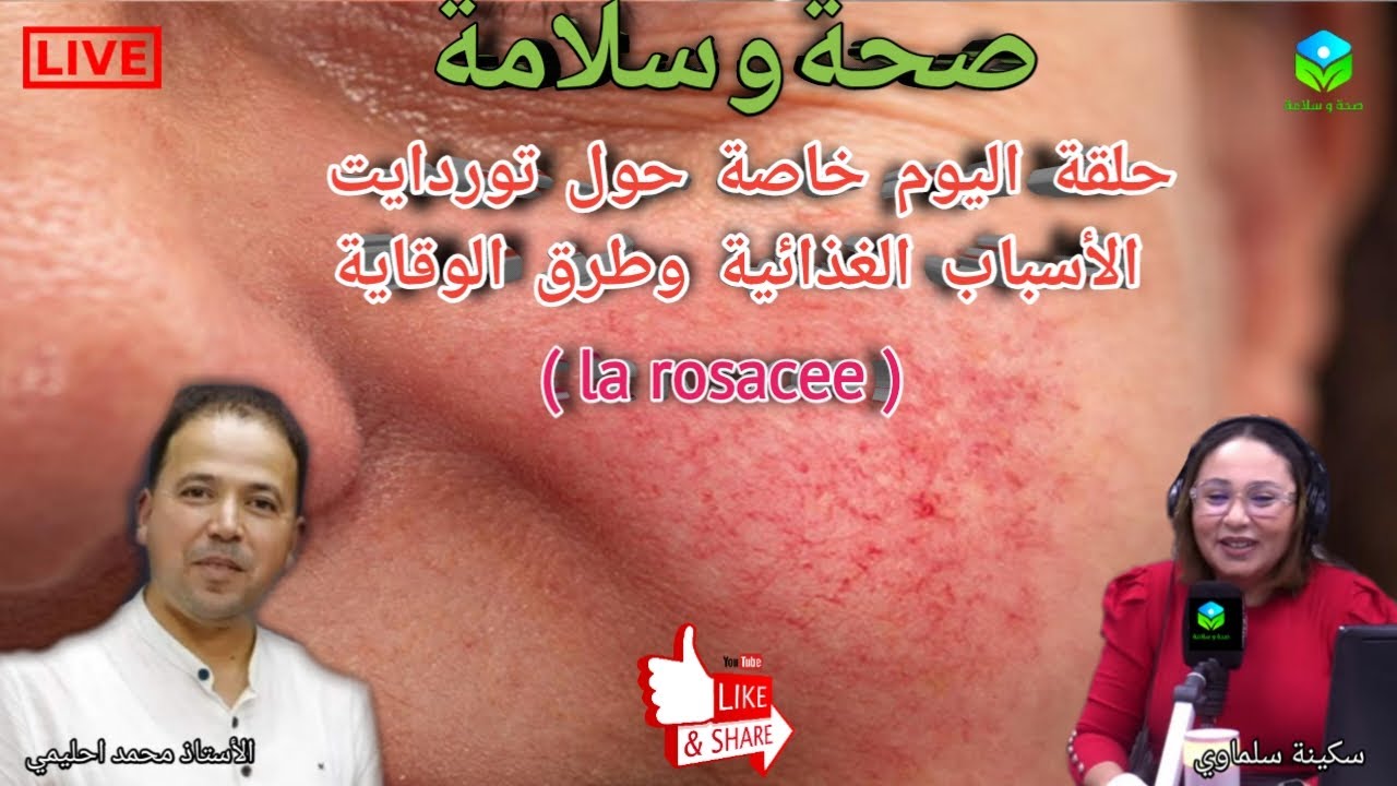🔴 حلقة اليوم خاصة حول توردايت ( la rosacee ) الأسباب الغذائية وطرق الوقاية مع الاستاذ محمد احليمي