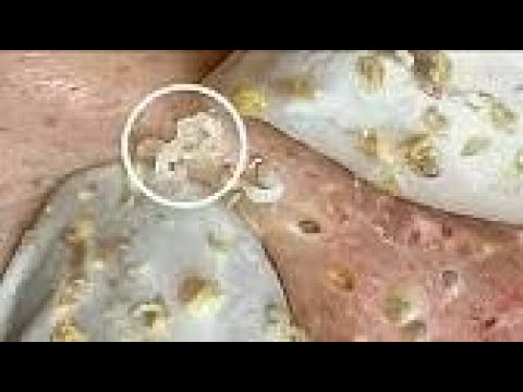BIG PIMPLE and BLACKHEAD POPPING (285) | Loan Nguyen - YouTube