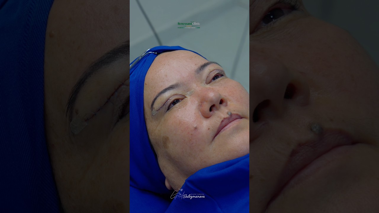 Др. Шахзода Сулейманова +998 90 027 77 76 #blefaroplastika #plasticsurgeon
