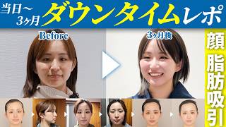 【顔の脂肪吸引】50cc吸引から3ヶ月間のリアルな経過お見せ…のサムネイル