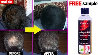 Grow Your Hair in Bald Patches | STOP Hair Fall With this Secret Hair Oil | Demika hair oil