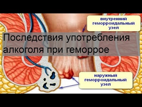 Последствия употребления алкоголя при геморрое