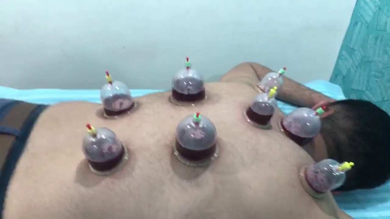 live streaming, Want to get rid from bad blood ?Cupping /Hijama for General well-being live streaming, Want to get rid from bad blood ?Cupping /Hijama for General well-being