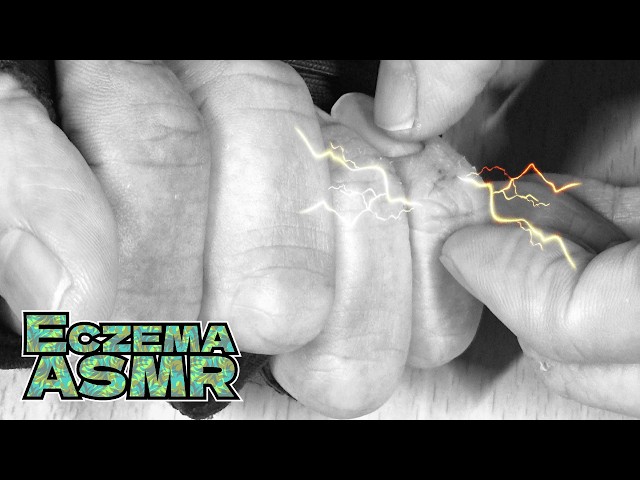 【痒すぎるアトピー性皮膚炎ASMR】猛烈に痒い小指と薬指を掻く音/癒し/リラックス効果/睡眠導入/マッサージ【モノクロ版】