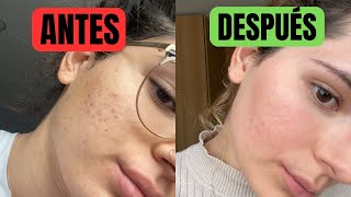 Cómo Curé mi Acné con (ESTE) Medicamento + Skincare by Minerva Chertó  197 views 3 weeks ago 7 minutes, 11 seconds