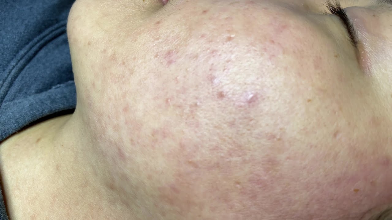 Treating Hidden Acne On Skin | Điều Trị Mụn Ẩn Trên Da - SacDepSpa#97
