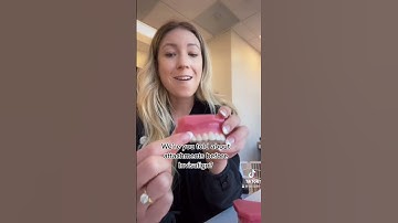 Attachments for Aligners #shorts