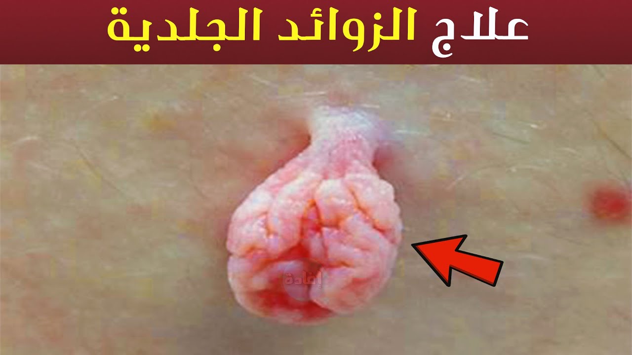 علاج الزوائد الجلدية - YouTube