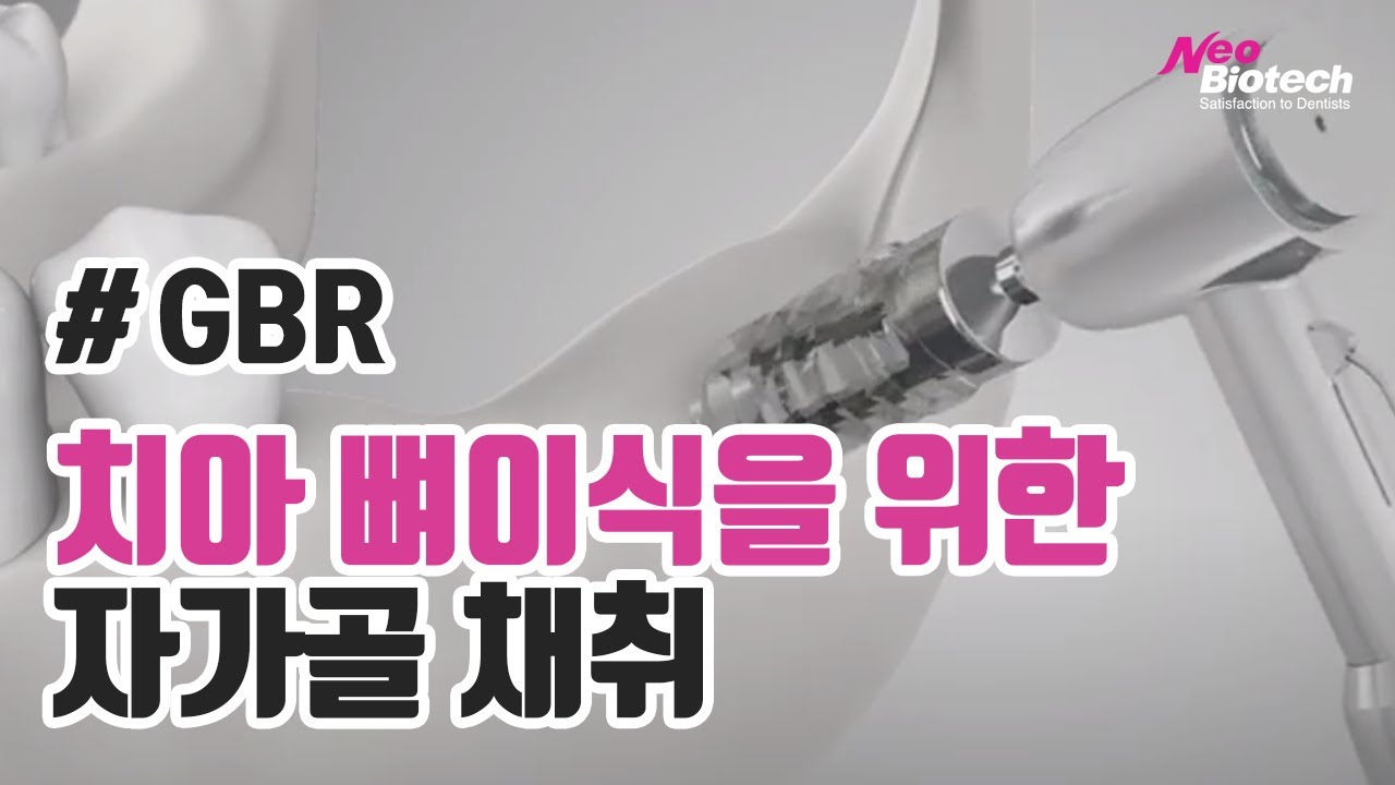 Update New 임플란트 뼈이식을 위한 자가 골 채취기 ACM(Auto Chip Maker)|Bone harvest by ACM | Neobiotech