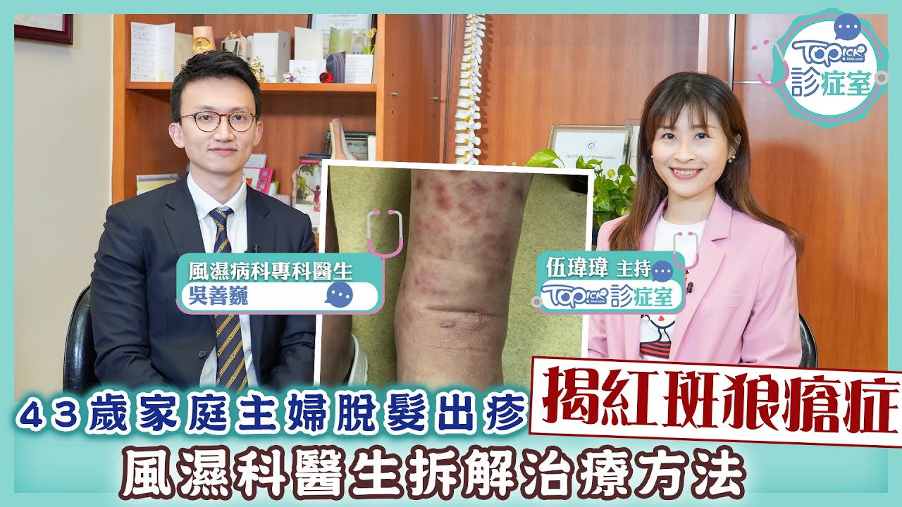 治療紅斑狼瘡的藥物治療-Fit 開有條路 EP266 - 香港開電視