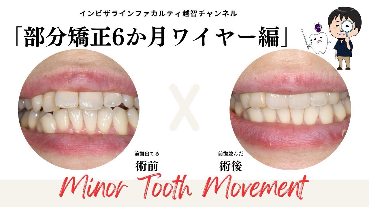 上の前歯のみの部分矯正（MTM）ブラケットセット動画 - YouTube