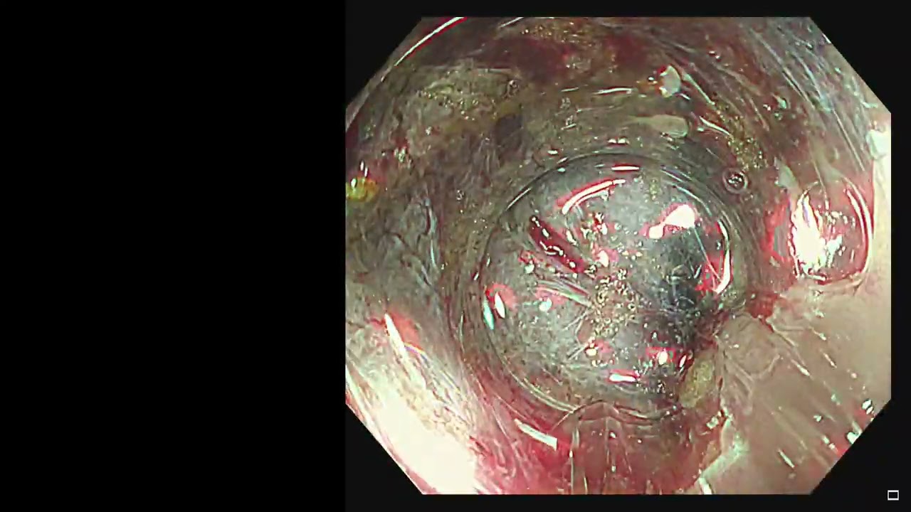 Colon ESD- Ascending colon 3cm post tattooing and biopsy with fibrosis(speed 2x)