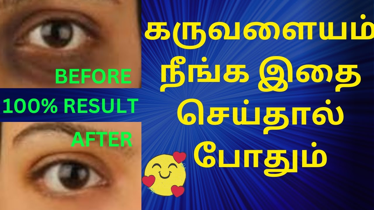 Dark circle remedy under eye removal home remedy கண் கருவளையம் நீங்க