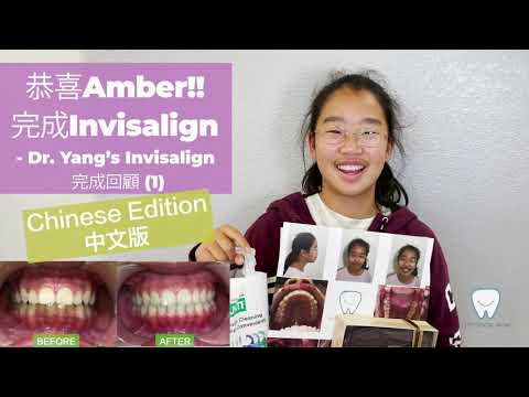 恭喜Amber完成Invisalign!_下顎後縮誘導骨生長裝置_ Chinese Edition 中文版＿  Dr. Yang’s Invisalign完成回顧 (1)