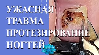 Травма ногтя. Эффективное лечение ногтей.