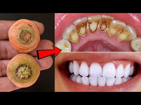 Video: Professioneel hoe om tande tuis te bleik