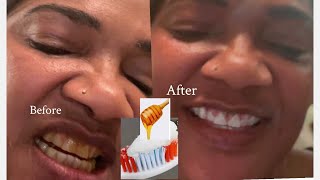Remove Stains From Teeth-How to Whiten Your Teeth-5 Home remedies