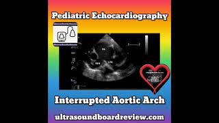 Interrupted Aortic Arch Echocardiography Findings