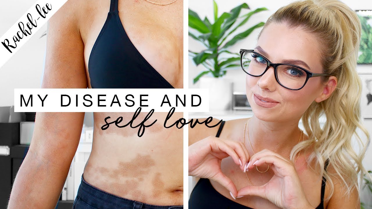 My Autoimmune Disease & How I Love My Skin | Motivation Monday