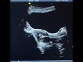 Embryo Transfer Procedure Embryo Transfer Procedure