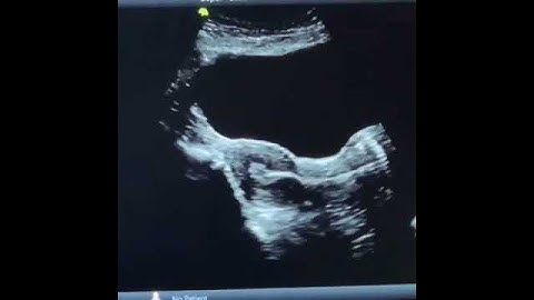 Embryo Transfer Procedure