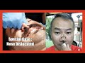 How to adjustment Special case nose dIslocated .He all the way from Australia |  TOP 3 Most chris