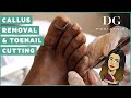 Callus removal and Toenail Cutting